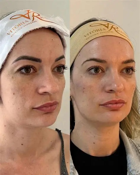 Botox resultado